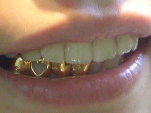 Grillz dentales, una moda peligrosa para la salud bucal - Artículos