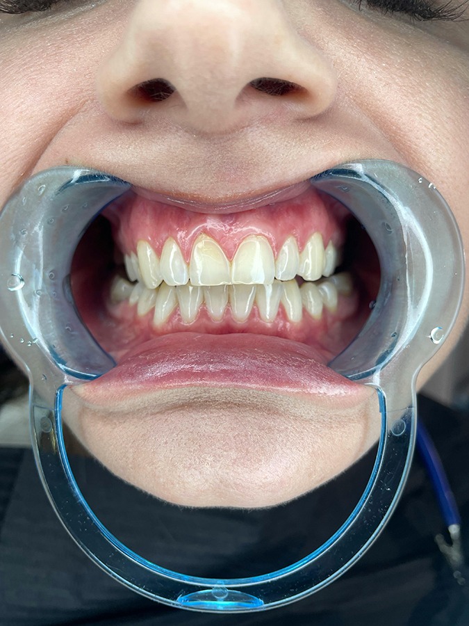 gingivitis y periodontitis